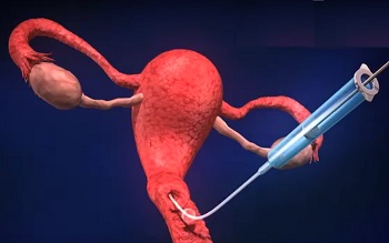 процесс переноса эмбрионов в матку