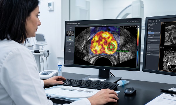 ФОТО: Технология Fusion-биопсии